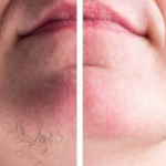 Haarentfernung Gesicht