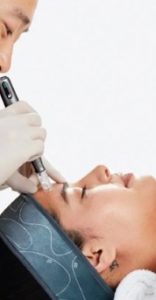 Luminfusion Needling